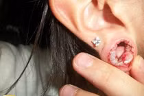 Cảnh báo nguy cơ biến chứng phù tai vì bấm lỗ tai