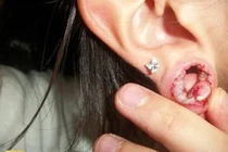 Cảnh báo nguy cơ biến chứng phù tai vì bấm lỗ tai