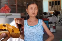 Tác hại khủng khiếp bệnh ăn uống vô độ của cô gái Quảng Nam