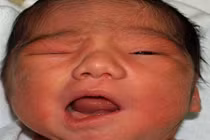 Nguyên nhân bất ngờ khiến trẻ em bị méo miệng mùa đông