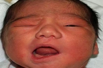 Nguyên nhân bất ngờ khiến trẻ em bị méo miệng mùa đông