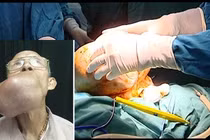 Phẫu thuật thành công khối u khổng lồ trên mặt cụ ông