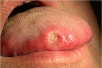 Những dấu hiệu ung thư mà đàn ông rất hay bỏ qua 