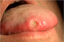 Những dấu hiệu ung thư mà đàn ông rất hay bỏ qua 