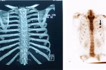 Cảnh rùng rợn cắt xương sườn để eo thon
