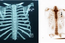 Cảnh rùng rợn cắt xương sườn để eo thon