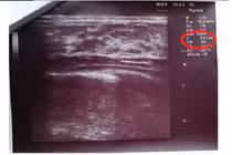 Hỗ trợ chống chọi với khối u vú kích thước 3 cm