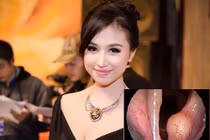 U thanh quản lành tính như MC Thanh Vân có chữa được không?