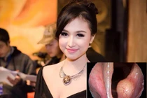 U thanh quản lành tính như MC Thanh Vân có chữa được không?