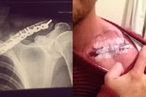 Kỷ vật có 1-0-2 của chàng trai gãy xương đòn, xương sườn