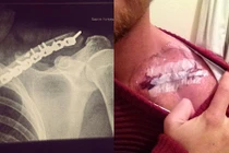 Kỷ vật có 1-0-2 của chàng trai gãy xương đòn, xương sườn