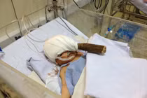 Em bé dao đâm xuyên đầu có khối tụ máu trong não