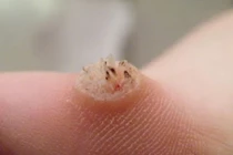 Hình ảnh khủng khiếp những căn bệnh dễ mắc ở chân 