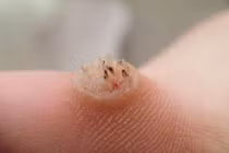 Hình ảnh khủng khiếp những căn bệnh dễ mắc ở chân 