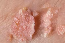 Những nhầm lẫn về bệnh sùi mào gà khiến bạn trả giá đắt