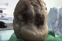 Hoảng hồn viên sỏi hơn 1kg trong bàng quang cụ ông