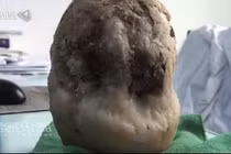 Hoảng hồn viên sỏi hơn 1kg trong bàng quang cụ ông