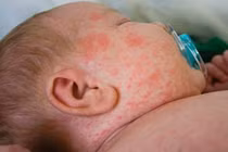 Nhiều nước châu Á bùng phát dịch sởi