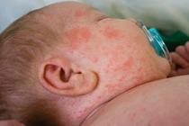 Nhiều nước châu Á bùng phát dịch sởi