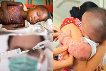 Những đại dịch sởi khủng khiếp khắp thế giới