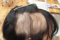 Thích nhổ tóc, nhổ lông vùng kín, dấu hiệu bệnh tâm thần