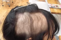 Thích nhổ tóc, nhổ lông vùng kín, dấu hiệu bệnh tâm thần