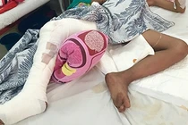 Đứt dây thần kinh, mạch máu do khỉ cắn