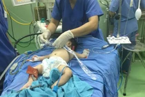 Bé trai biến thành gái vì có 2 bộ phận sinh dục