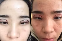 Thảo Spa 465 Thụy Khuê: Cắt mí gây nhiễm trùng cho khách