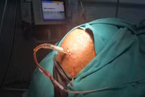 Cận cảnh kỹ thuật khoan sọ não bệnh nhân 