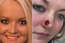 Thiếu nữ bị biến dạng khuôn mặt khủng khiếp do ung thư da