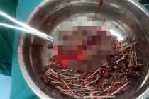 Mổ lấy 200 cái đinh, dị vật lạ trong bụng bé trai 