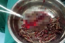 Mổ lấy 200 cái đinh, dị vật lạ trong bụng bé trai 