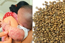 Phòng dịch sởi bằng hạt mùi và cây thuốc nam