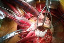 Liên tiếp cứu sống nhiều ca bệnh tim hiếm đầu năm 2017