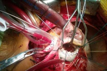 Liên tiếp cứu sống nhiều ca bệnh tim hiếm đầu năm 2017