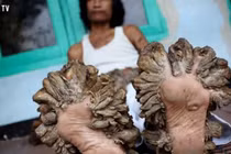 Căn bệnh đáng sợ có thật khủng khiếp hơn phim kinh dị