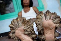 Căn bệnh đáng sợ có thật khủng khiếp hơn phim kinh dị