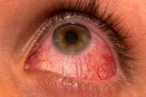 Cảnh báo dịch Rubella bùng phát cận Tết