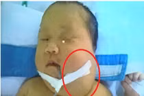 Bé gái mang khối bướu quái dị lần đầu phát hiện ở Việt Nam