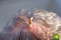 Những hình ảnh khủng khiếp về bệnh tật xưa và nay