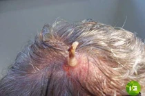 Những hình ảnh khủng khiếp về bệnh tật xưa và nay