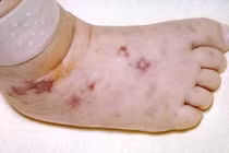  Biến chứng kinh hoàng của viêm màng não mô cầu