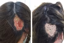 Thiếu nữ bỏng nặng, hoại tử da đầu sau hấp dưỡng tóc