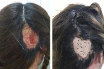 Thiếu nữ bỏng nặng, hoại tử da đầu sau hấp dưỡng tóc