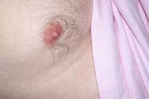 Dấu hiệu cảnh báo sớm ung thư vú ở nam giới