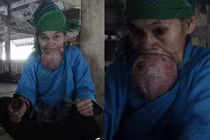 Cụ bà 60 tuổi hơn nửa đời chiếc đeo lưỡi khổng lồ