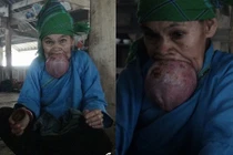 Cụ bà 60 tuổi hơn nửa đời chiếc đeo lưỡi khổng lồ