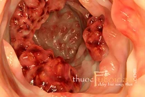 10 bệnh ung thư đàn ông Việt mắc nhiều nhất