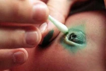 Những điều cần biết về bệnh nhiễm trùng máu rất nguy hiểm